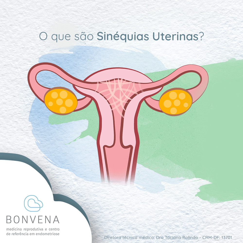 O Que S o Sin quias Uterinas Bonvena Medicina Reprodutiva Em Bras lia o-que-s-o-sin-quias-uterinas-bonvena-medicina-reprodutiva-em-bras-lia