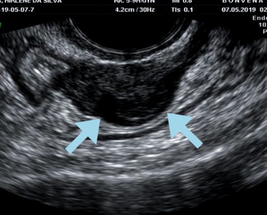 Ultrassonografia Transvaginal com Preparo Intestinal em Brasília | Bonvena Medicina Reprodutiva